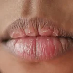 10 Penyebab Bibir Kering yang Sering Diabaikan