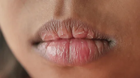 10 Penyebab Bibir Kering yang Sering Diabaikan 10 Penyebab Bibir Kering yang Sering Diabaikan