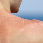 5 Cara Sederhana Menghindari Kanker Kulit