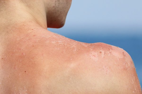 5 Cara Sederhana Menghindari Kanker Kulit 5 Cara Sederhana Menghindari Kanker Kulit