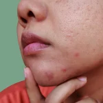 5 Cara Mencegah Iritasi Kulit di Sekitar Dagu