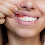 7 Cara Sederhana Cegah Radang Gusi