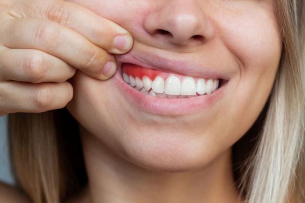 7 Cara Sederhana Cegah Radang Gusi