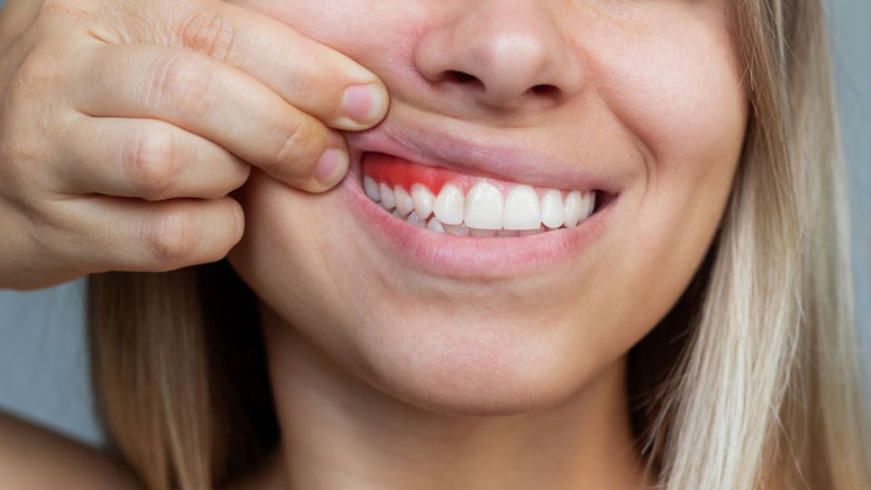7 Cara Sederhana Cegah Radang Gusi