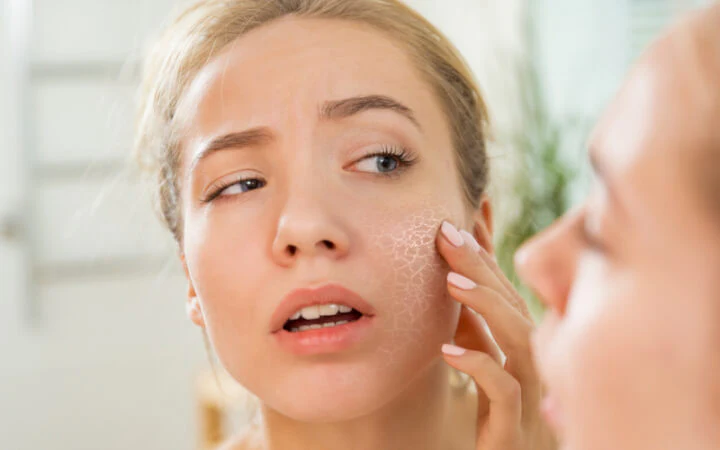 10 Cara Mengatasi Kulit Kering dengan Efektif