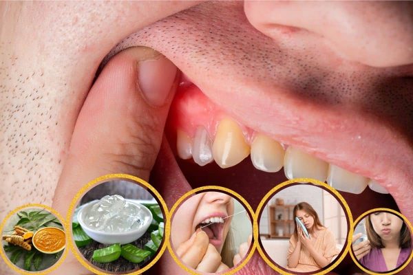 10 Cara Mengatasi Gusi Berdarah dengan Bahan Rumahan