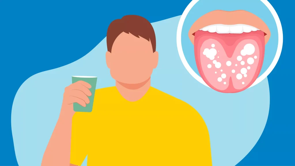 7 Cara Alami Mengatasi Lidah Putih dan Berlapis